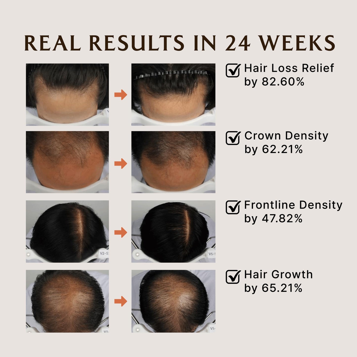 Lador Dermatical Hair-Loss Thin Shampoo 530ml